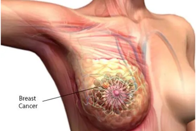 Emotional Support During Breast Cancer Treatment